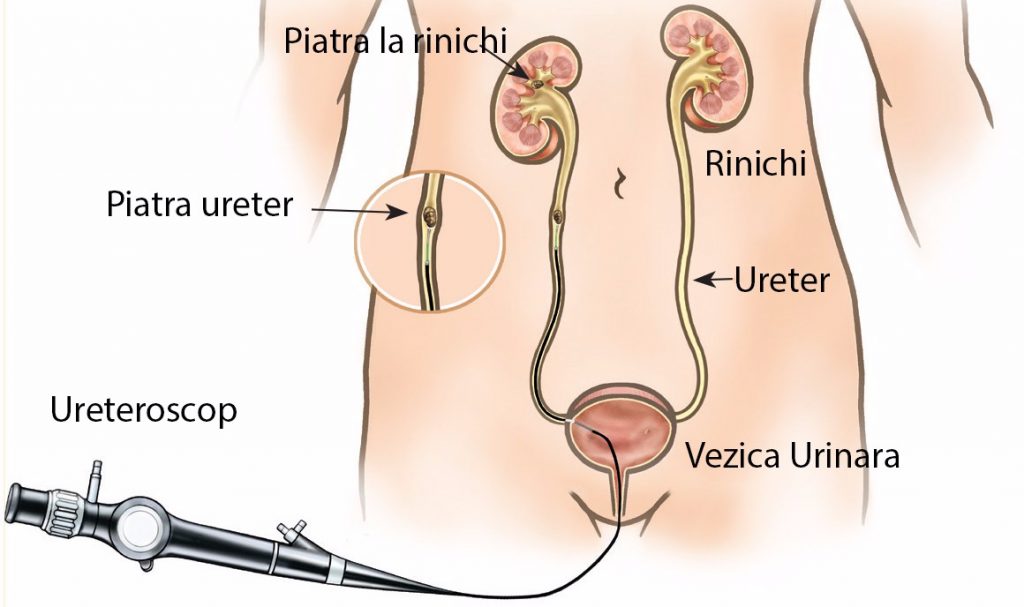 ureteroscopie